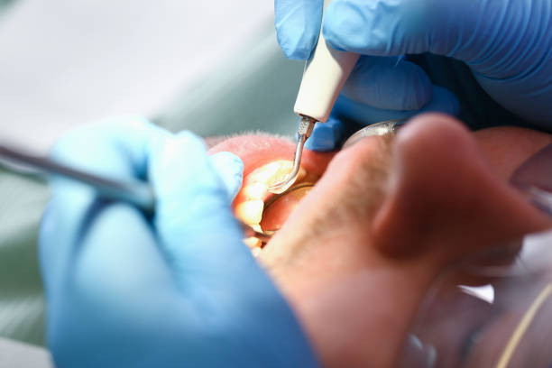 Best Knocked-Out Tooth (Avulsed Tooth) Treatment in Mingo Junction, OH